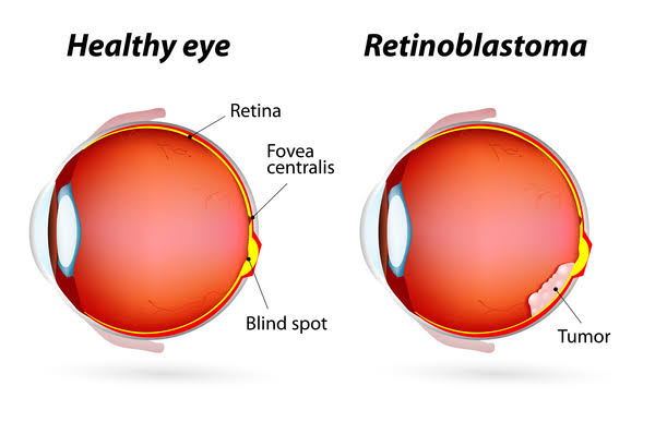 Sembuh dari kanker mata retinoblastoma