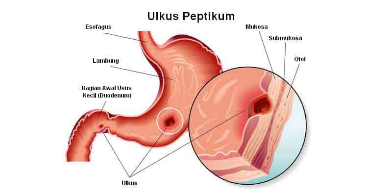 Testimoni Maagh Akut Sembuh Alga Kolagen Alga Gold